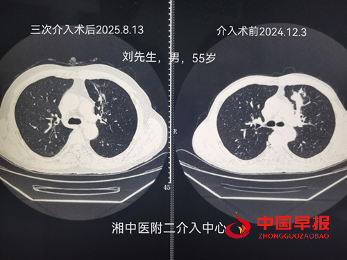湖南中医药大学放射介入中心创新治疗模式显奇效(图1) 湖南中医药大学放射介入中心创新治疗模式显奇效(图1)